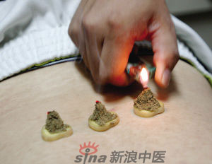 灸法的種類  你知道多少？